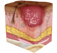 stage two pressure sore