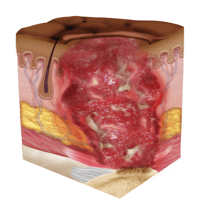 stage four pressure sore