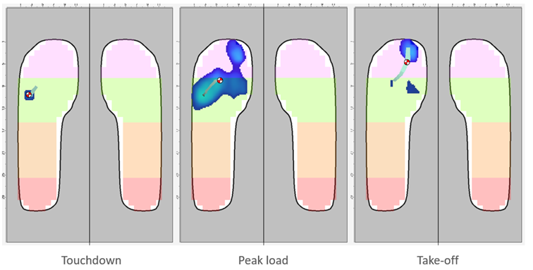 Plantar pressure from a basketball player, collected using XSENSOR's Intelligent Insoles | Pro.