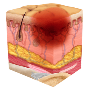 Pressure Injury 101: The 4 Stages