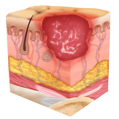 Pressure Injury 101: The 4 Stages