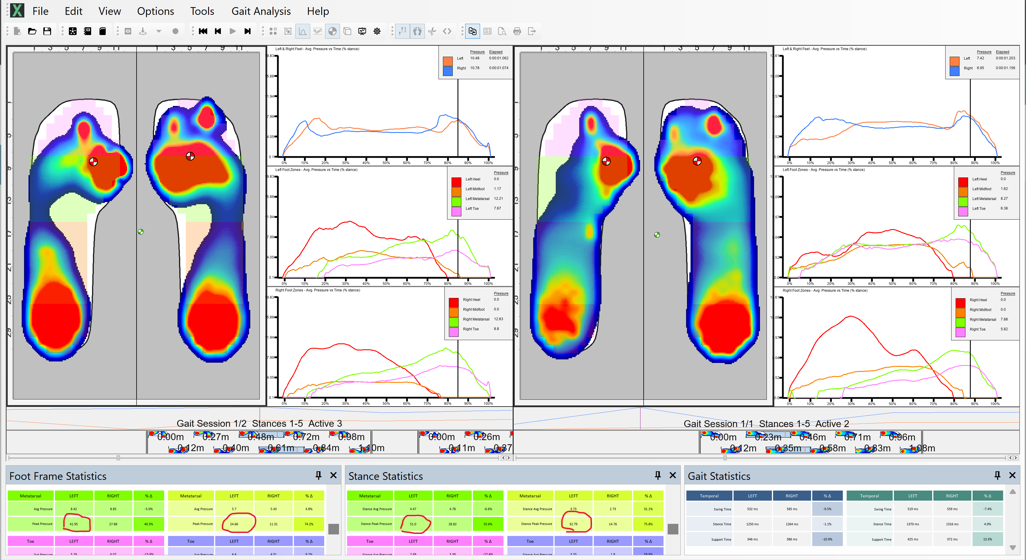 XSENSOR's Pro Foot & Gait software showing a Severe Hallux Abducto Valgus (Bunion).