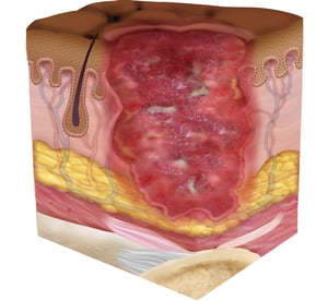 Stage 3 Pressure Injury Darkly Pigmented Skin