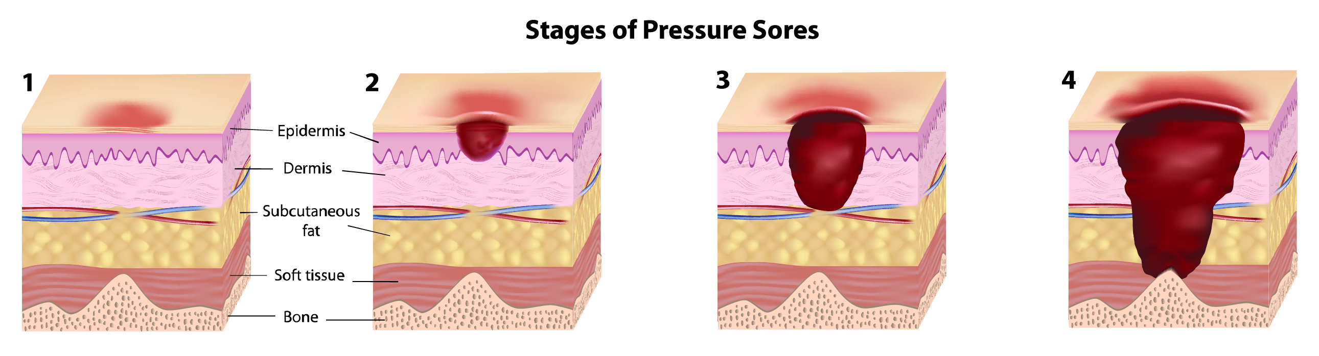 4 Stages of a Wheelchair Pressure Sore