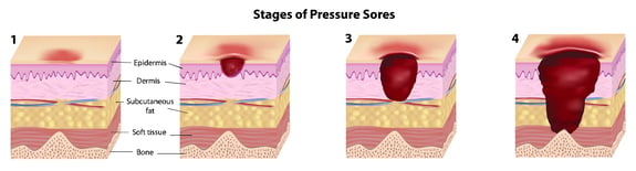 4 stages of pressure ulcers