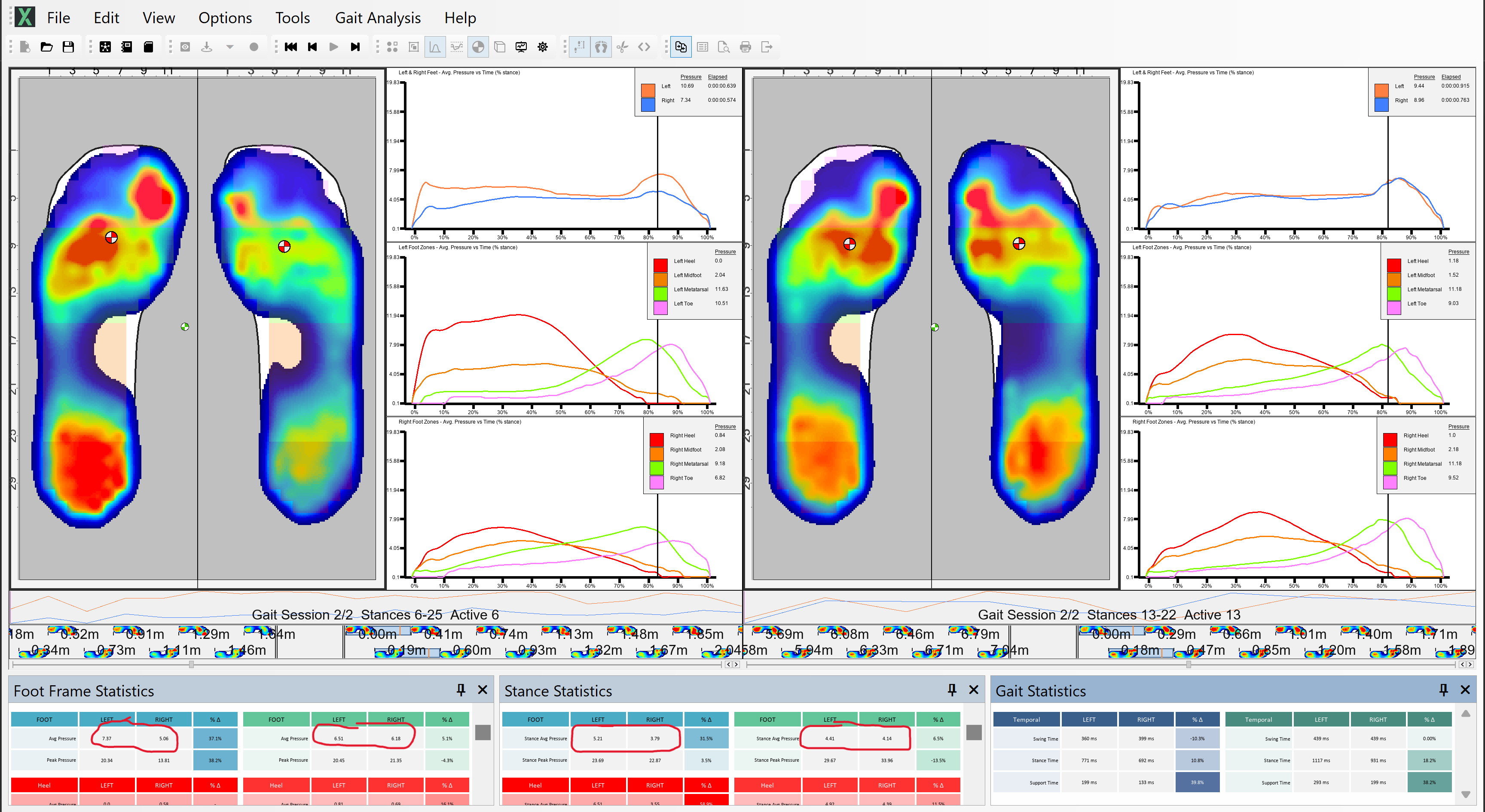 XSENSOR's Pro Foot & Gait software showing a Tibialis Posterior Tendinopathy.
