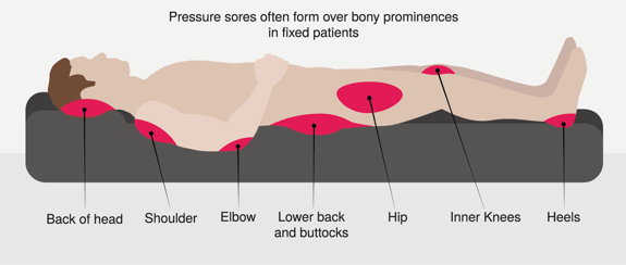 where pressure sores form on the body