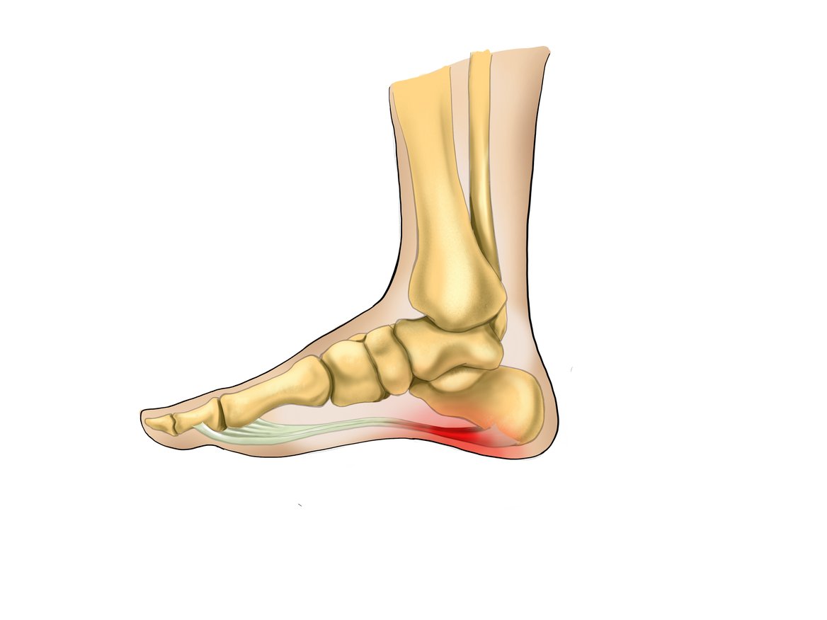 Pressure Points for Plantar Fasciitis: Insights into Relief Options