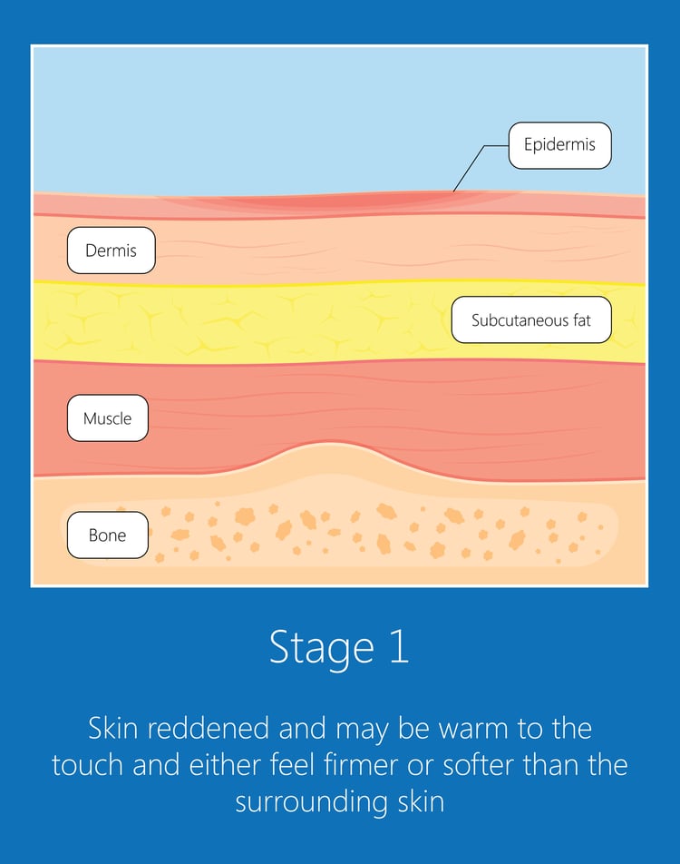 Pressure Injury 101 Stage 1 Pressure Ulcers