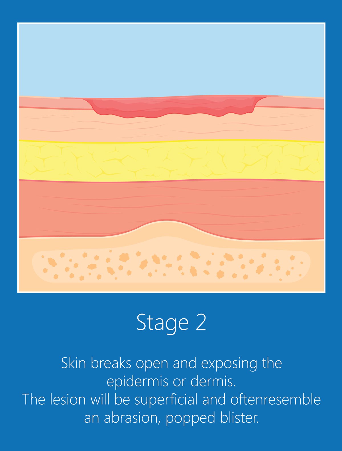 Pressure Injury 101 Stage 2 Pressure Ulcers