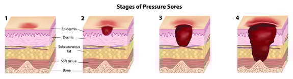 4 stages of pressure ulcers